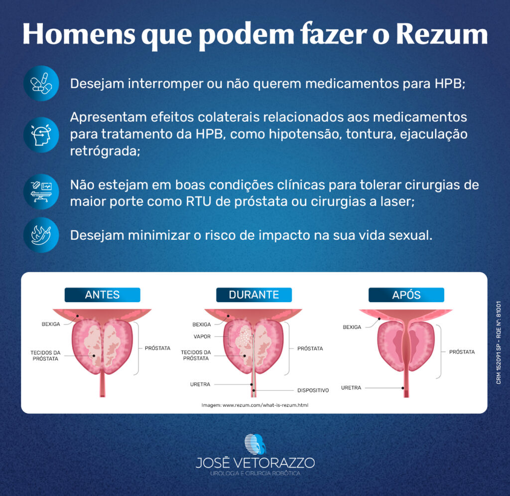 Infográfico mostra próstatas e revela condições que os candidatos ao procedimento Rezum devem ter