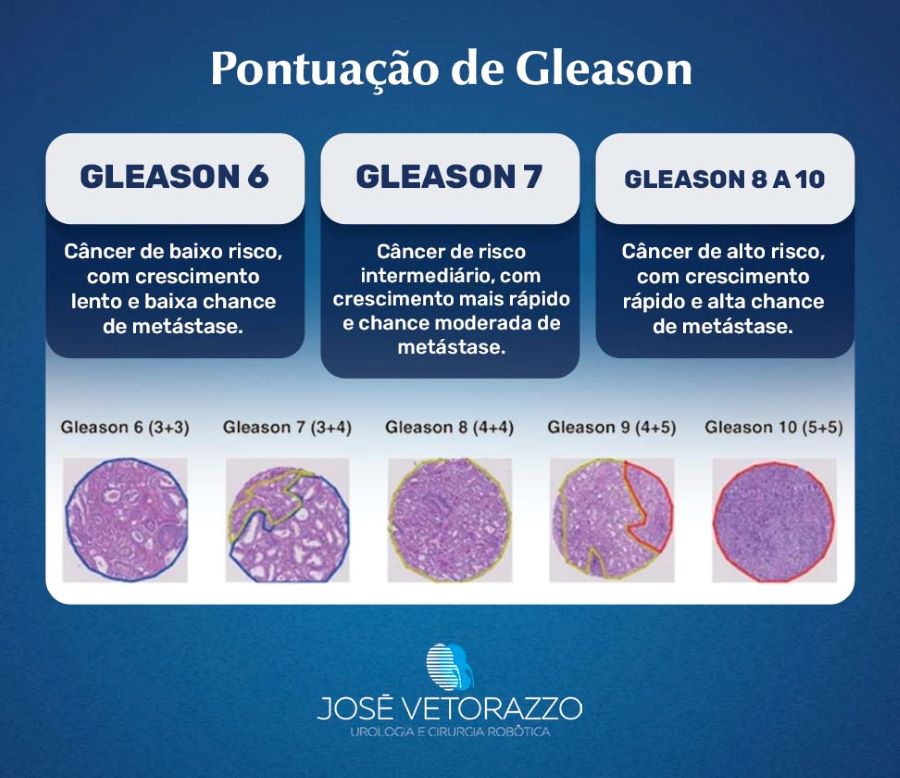 Infográfico com a pontuação de Gleason: 
Gleason 6: câncer de baixo risco, com crescimento lento e baixa chance de metástase;
Gleason 7: câncer de risco intermediário, com crescimento mais rápido e chance moderada de metástase;
Gleason 8 a 10: câncer de alto risco, com crescimento rápido e alta chance de metástase.