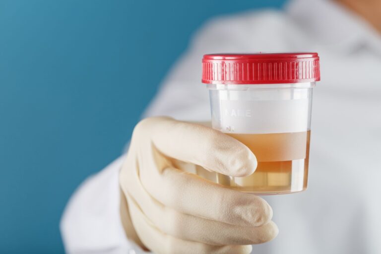 Frasco de exame com coleta de material, indicando possível sangue na urina (hematúria), que pode estar ligada a doenças urológicas como HPB, câncer de próstata ou infecções