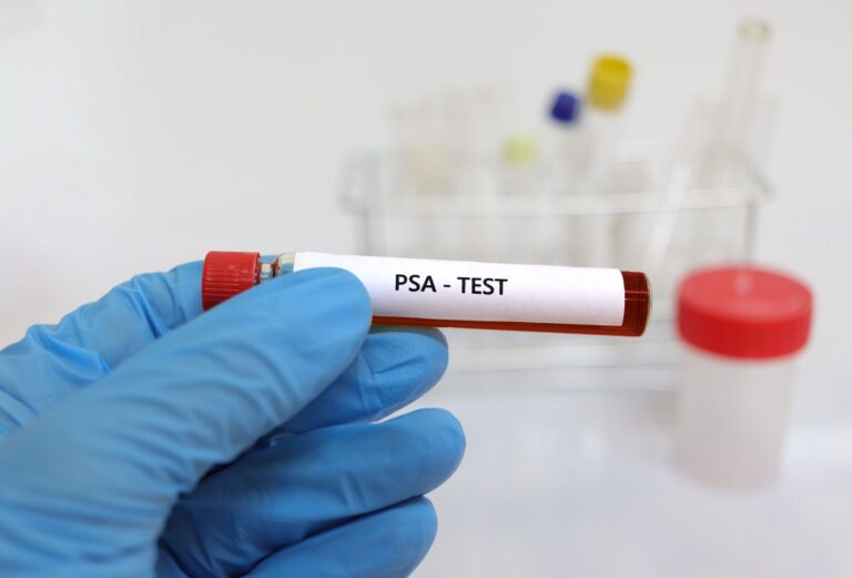 Tubo de sangue identificado como PSA test sendo segurado por mão com luva em laboratório, ilustrando a dúvida se PSA alto sempre indica câncer de próstata.